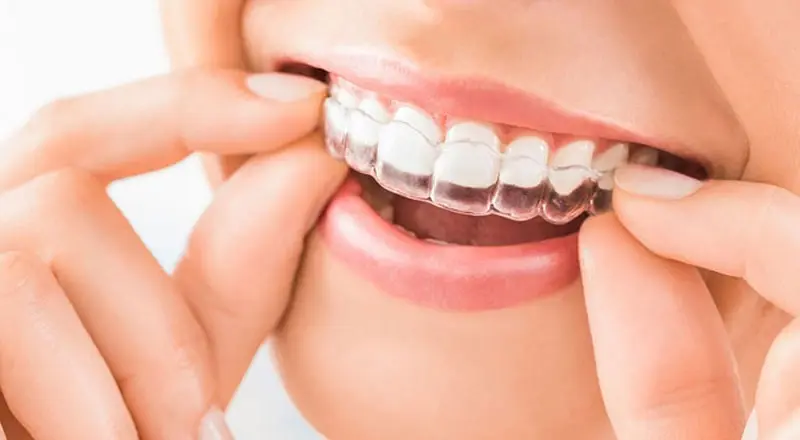 How Much is Invisalign With Insurance